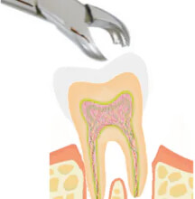 不用歯の抜歯